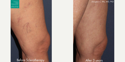 Sclerotherapy before and after photo
