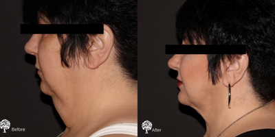 Tumescent Liposuction before and after photo