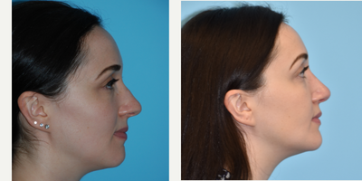 Revision Rhinoplasty before and after photo