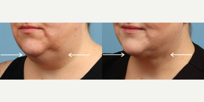 Smart Lipo before and after photo