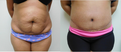 Tummy Tuck before and after photo