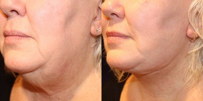 Facelift before and after photo