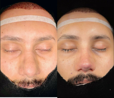 Hair Transplant before and after photo