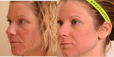 Halo Laser before and after photo