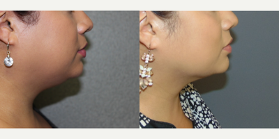 Liposuction before and after photo