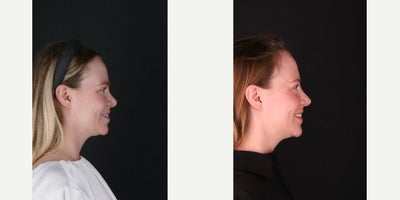 Revision Rhinoplasty before and after photo