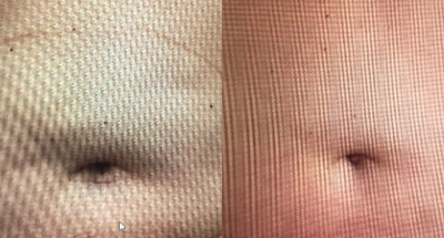 SculpSure before and after photo