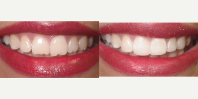 Dental Bonding before and after photo