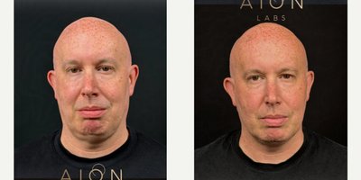 Endolift before and after photo