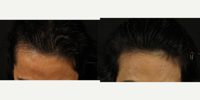 Hair Loss Treatment before and after photo