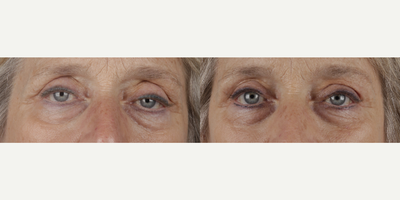 Ptosis Surgery before and after photo