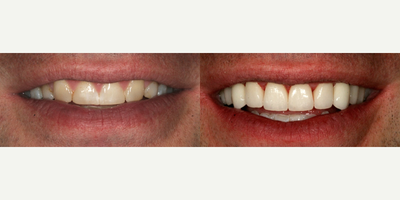 Smile Makeover before and after photo