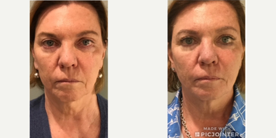 Bellafill before and after photo