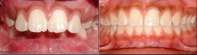 Braces before and after photo