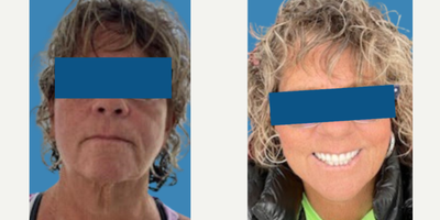 Facelift before and after photo