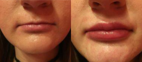 Juvederm before and after photo