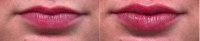 Restylane before and after photo