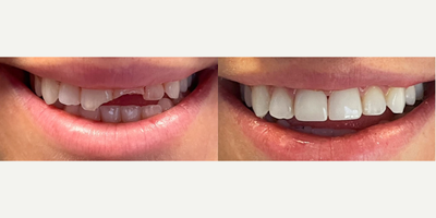 Tooth Repair before and after photo