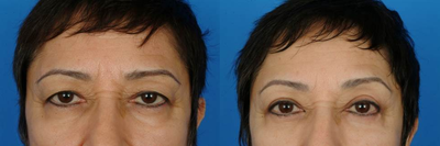 Eyelid Surgery before and after photo