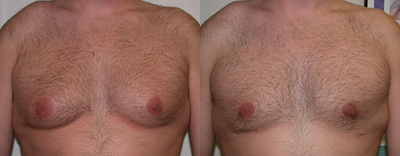 Gynecomastia Surgery before and after photo