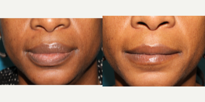 Lip Reduction before and after photo