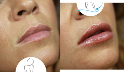 Dermal Fillers before and after photo