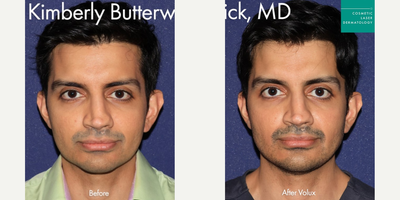 Dermal Fillers before and after photo