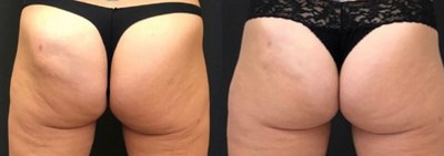 Emsculpt before and after photo