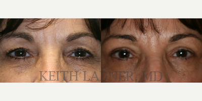 Eyelid Surgery before and after photo