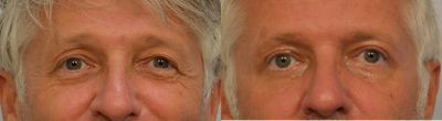 Eyelid Surgery before and after photo