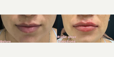 Lip Fillers before and after photo