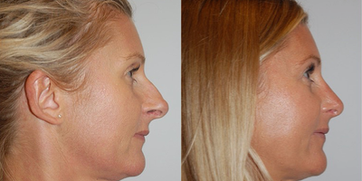 Rhinoplasty before and after photo