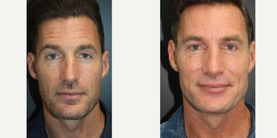 Sculptra before and after photo