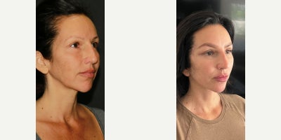 Deep Plane Facelift before and after photo