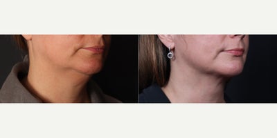 FaceTite before and after photo