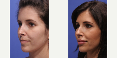 Facial Fat Transfer before and after photo