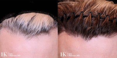 FUE Hair Transplant before and after photo