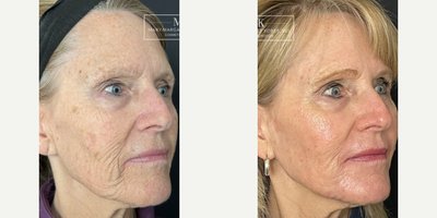 Laser Resurfacing before and after photo