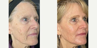 Laser Resurfacing before and after photo