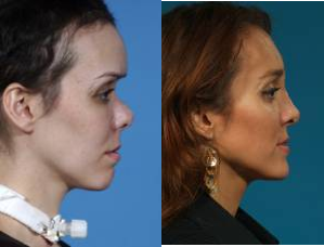 Rhinoplasty before and after photo