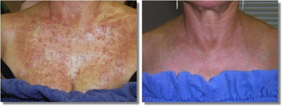 IPL before and after photo