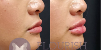 Juvederm before and after photo
