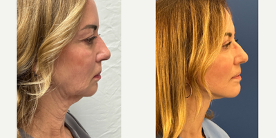 Neck Lift before and after photo