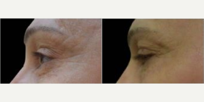 Skin Tightening before and after photo
