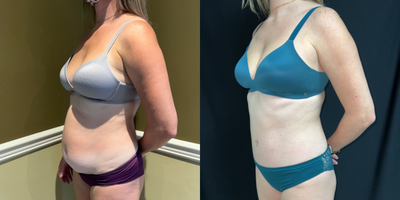 Tummy Tuck before and after photo