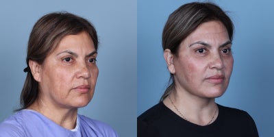 Deep Plane Facelift before and after photo