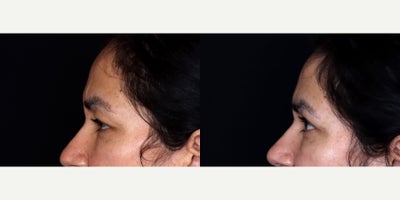 Eyelid Surgery before and after photo