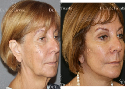 Facelift before and after photo