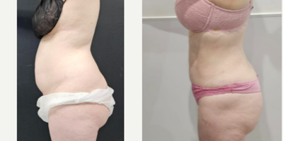 Vaser Liposuction before and after photo