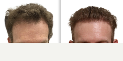 ARTAS Robotic Hair Transplant before and after photo